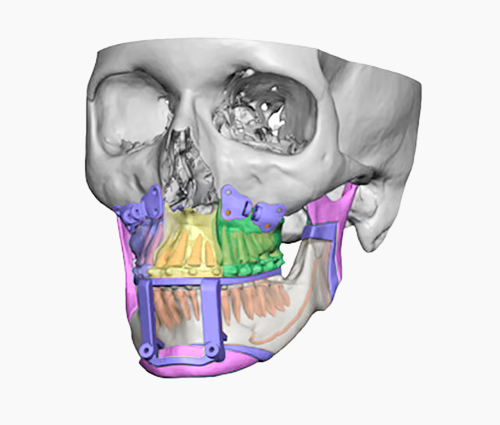 Virtual Surgery Planning (VSP)